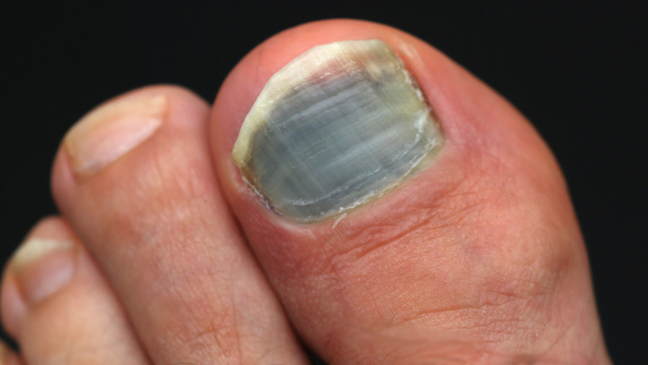 Black Toenails Causes And How To Get Rid Of Them Starts At 60 Images