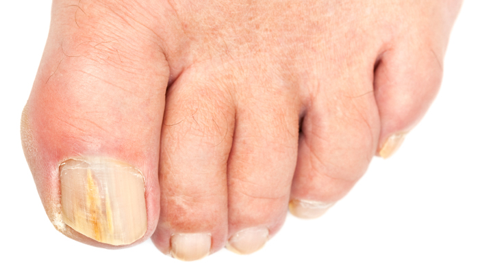 10 top tips for ageing toenails - Starts at 60