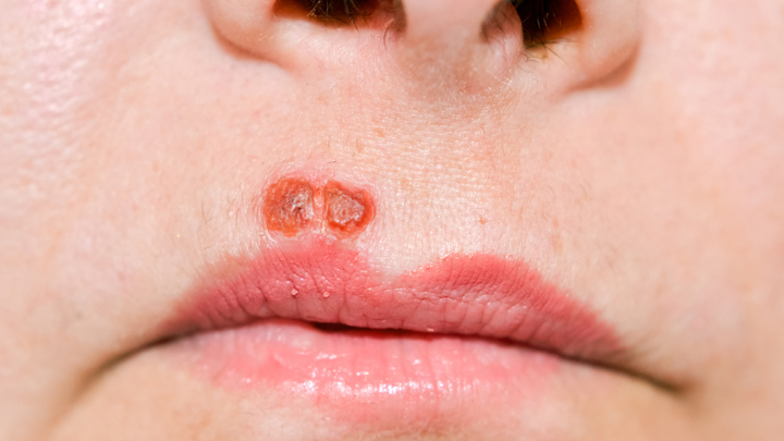 how-to-get-rid-of-cold-sores-naturally-and-fast-starts-at-60