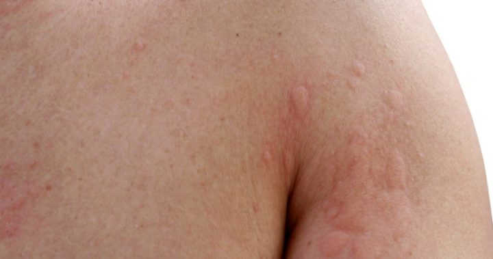 7-reasons-why-you-might-be-breaking-out-in-hives