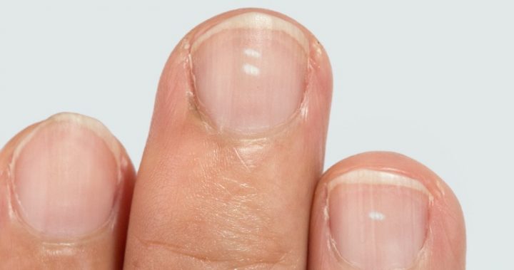 What you need to know about those white spots on your nails - Starts at 60 What you need to know about those white spots on your nails - Starts at 60