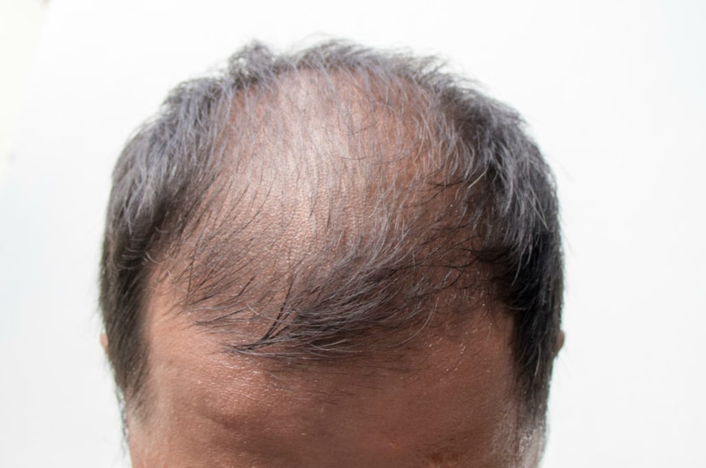 Hair today, gone tomorrow: The latest hair loss treatments for men and ...