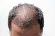 Hair Today Gone Tomorrow The Latest Hair Loss Treatments For Men And 