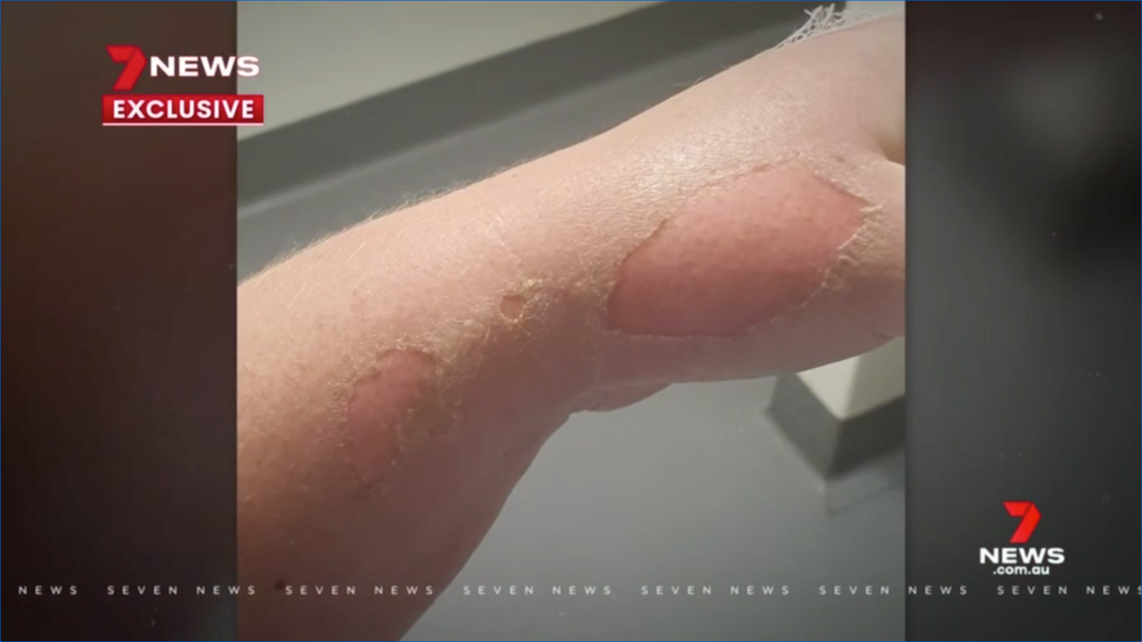 Sunbeam CrockPot explodes like ‘a bomb’ ‘permanently scarring’ woman