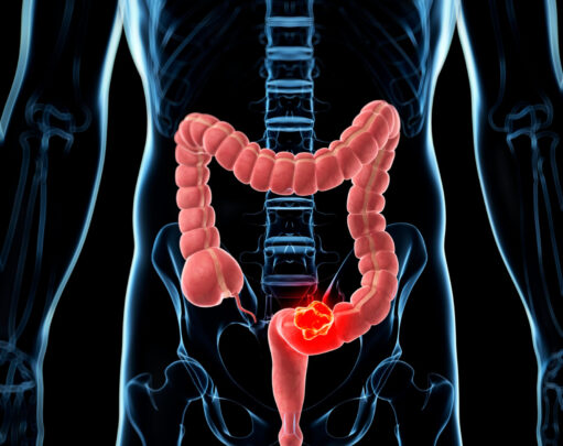 Bowel cancer – some positive news - Vimarsana News