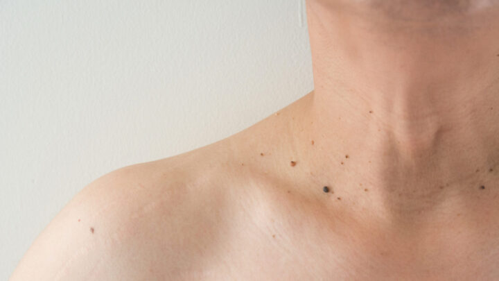 Many people get skin tags as they get older, but there are safe ways to remove them. Source: Getty